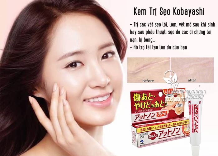 Kem trị sẹo mờ thâm Kobayashi Nhật Bản 15g
